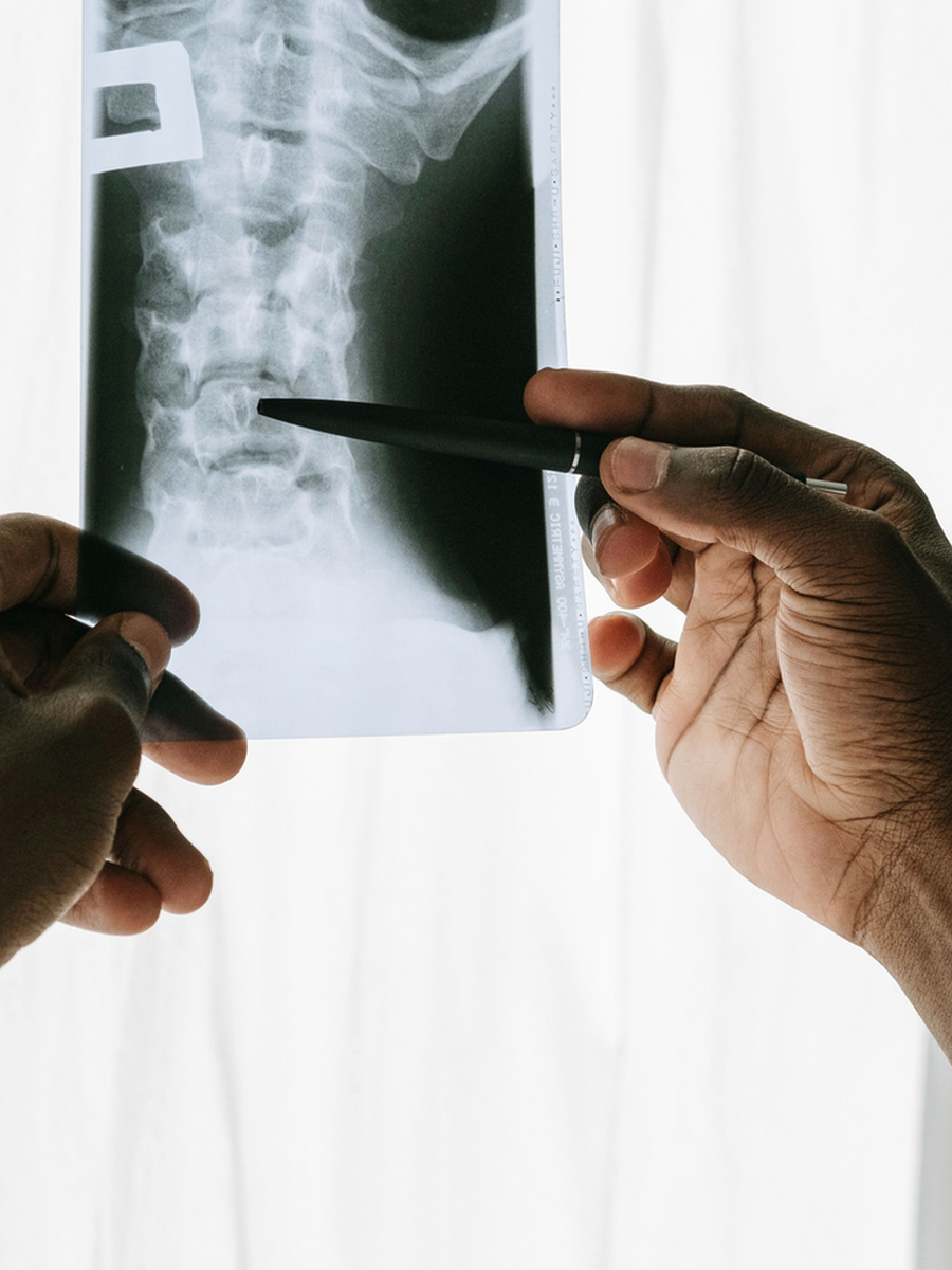 Arthrose vertébrale : facettes, raideur, sténose et traitement