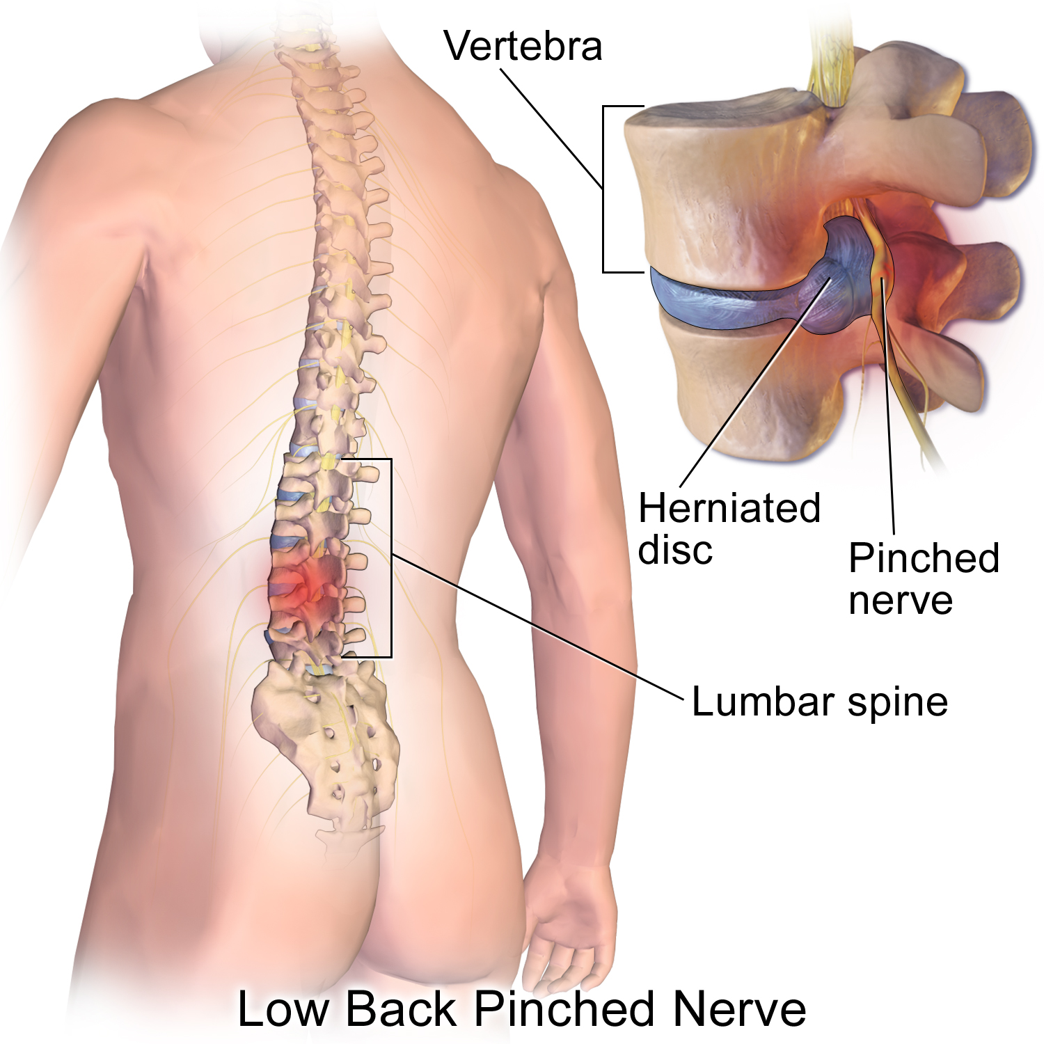 Illustration of a lumbar disc herniation and its relationship to nearby neural structures.