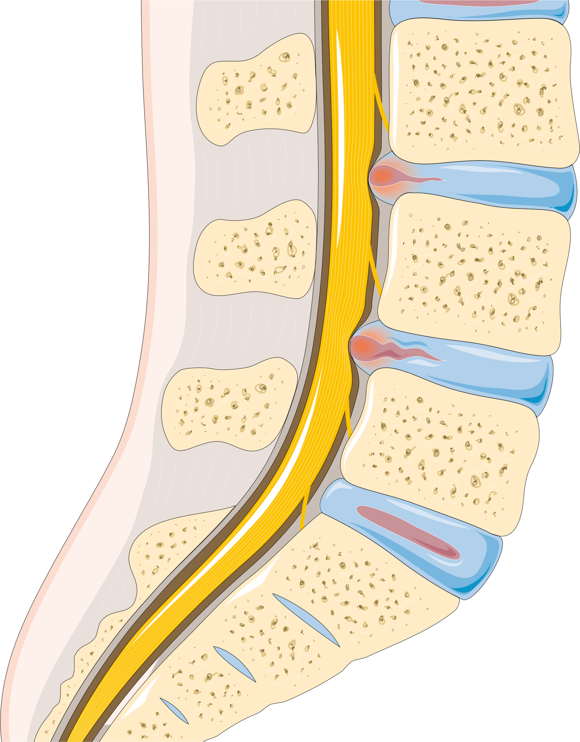 Schematic representations of disc changes and displaced disc material.
