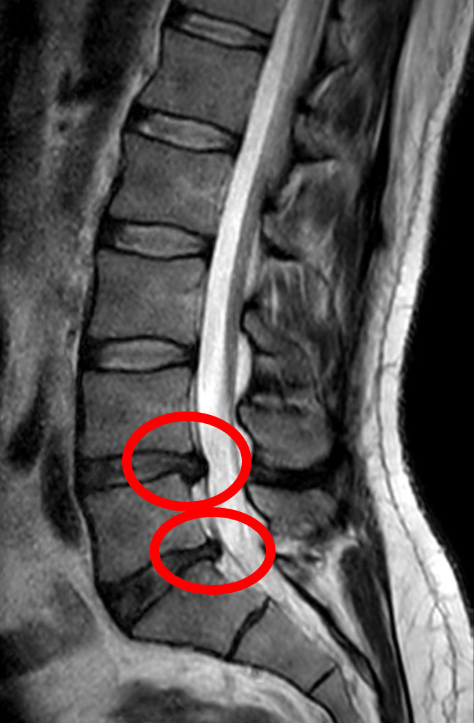 Example of lumbar MRI described by the source as showing a left paramedian L4–L5 disc herniation.