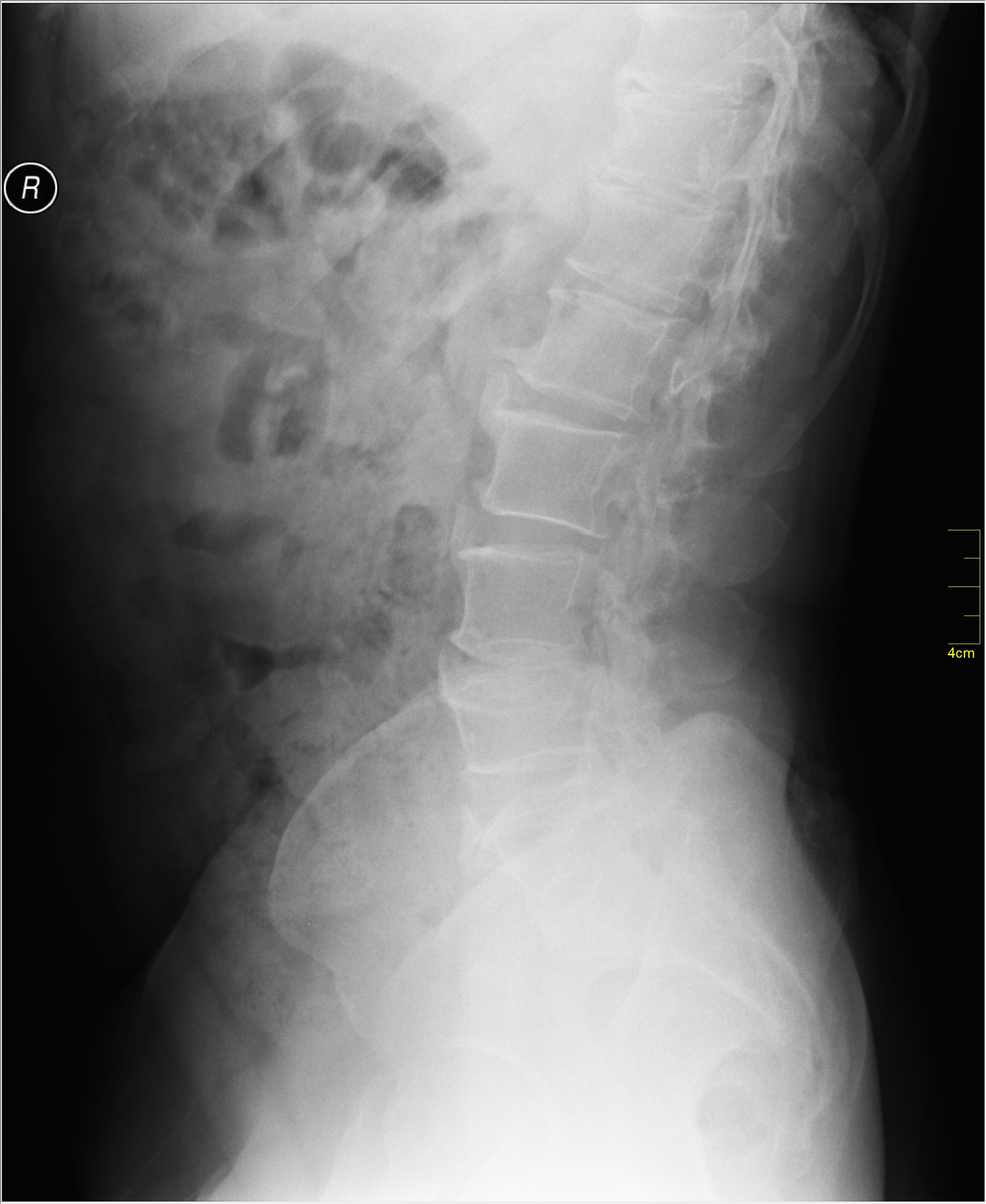Example of a lateral radiograph of the lumbar spine.